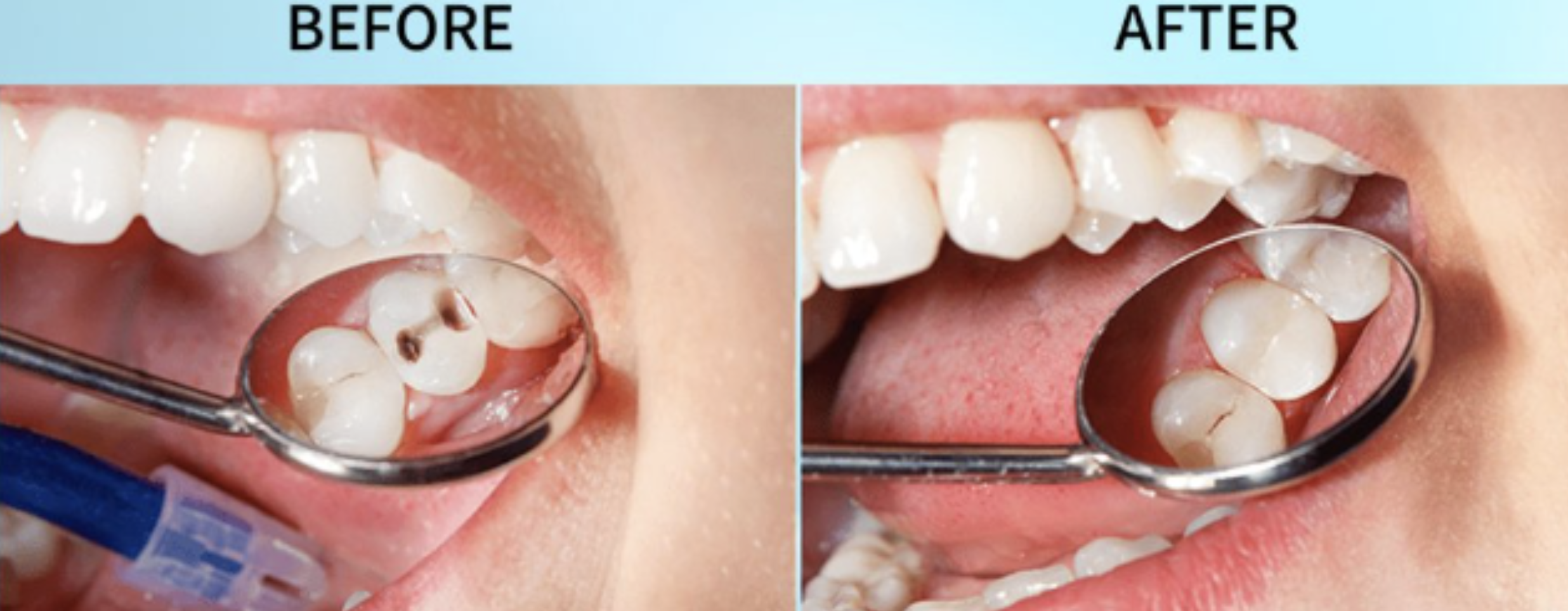 Cavity detection and treatment with iTero and Solea
