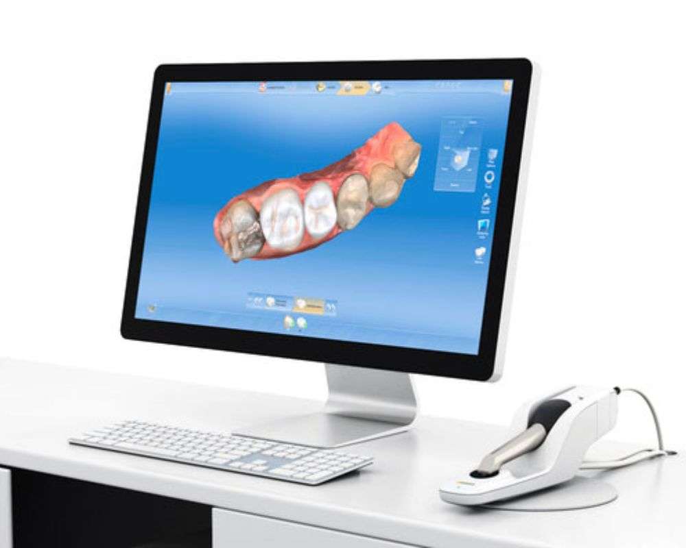 Cerec AI Design Cerec AI computer designing same-day ceramic crowns
