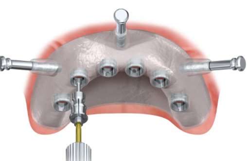 Full arch guide with anchor pins