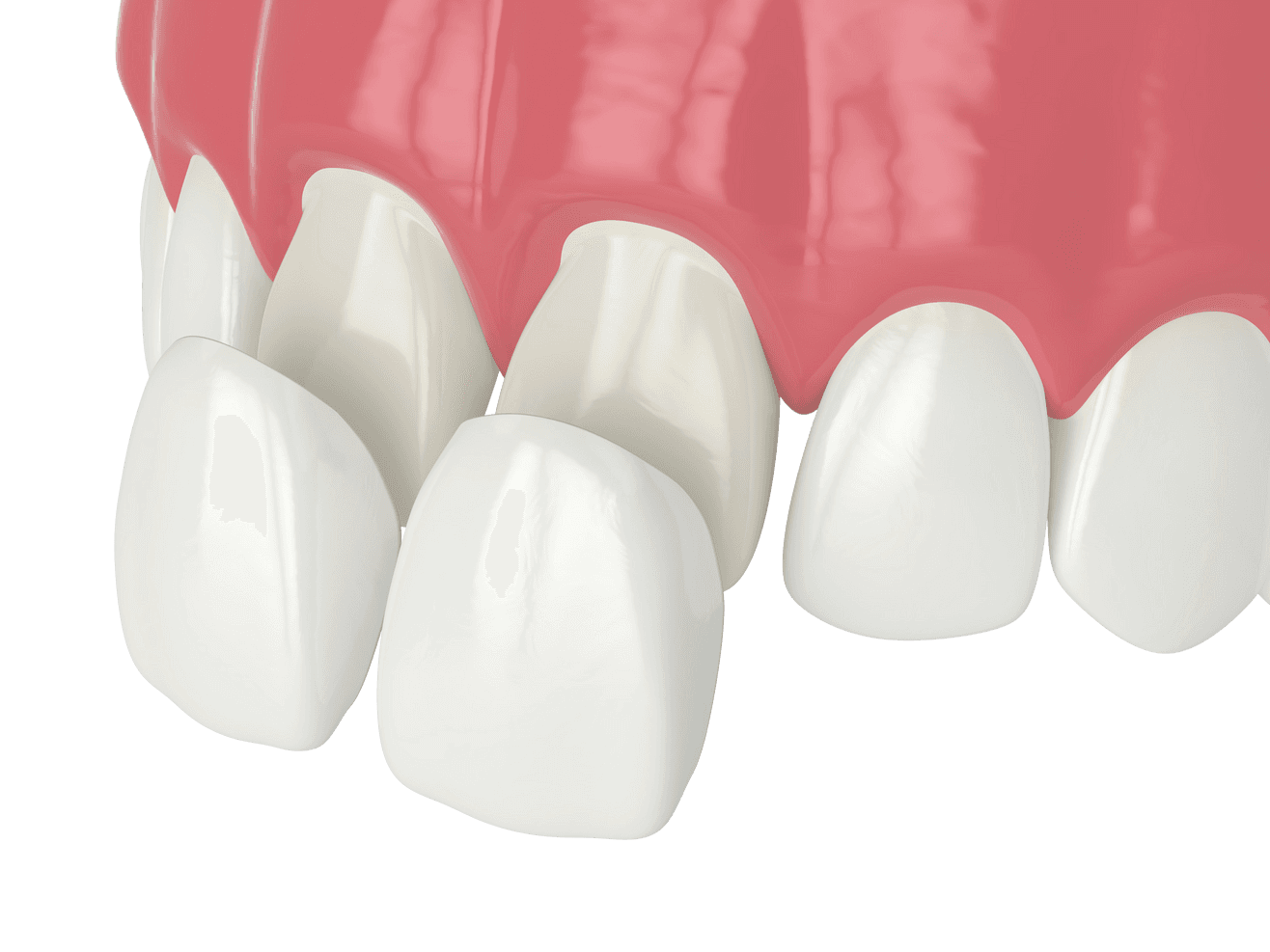 How Dr. Shi applies veneers