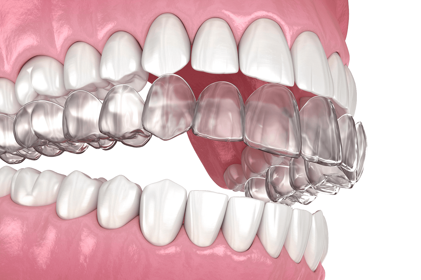 Invisalign for oral and overall health