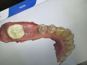 Missing tooth before implant