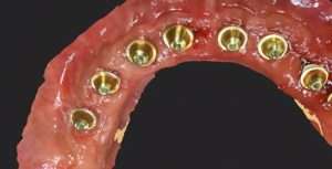 Multiunit Abutments Multiunit abutments