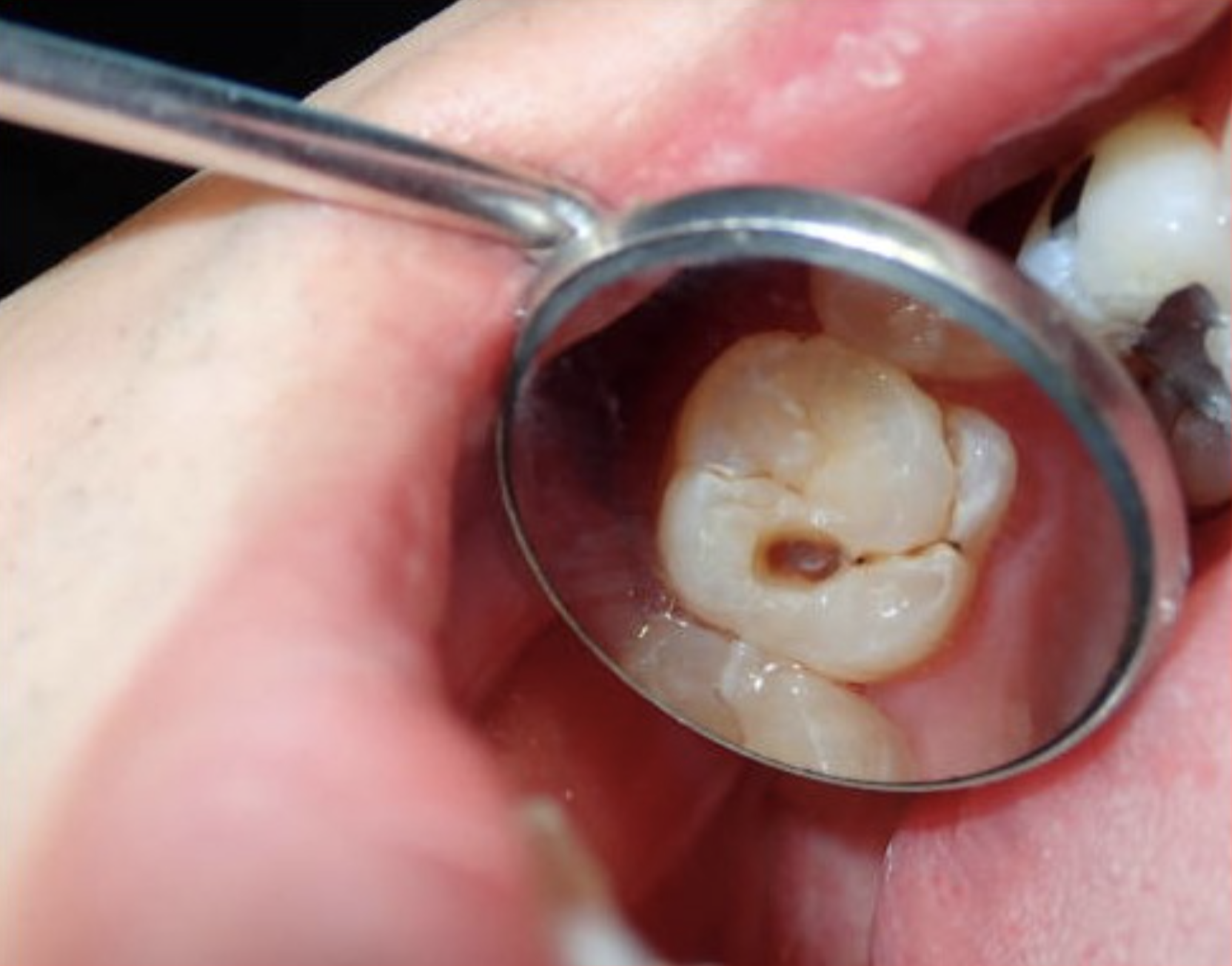 Occlusal cavities on chewing surfaces