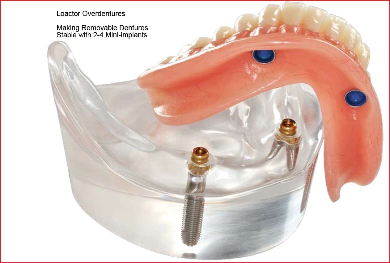 Overdenture