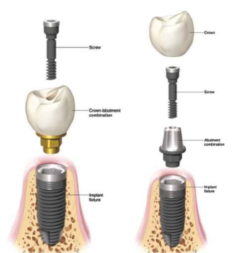 Single implant crown