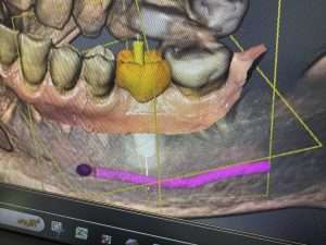 Surgical guide design using virtual tooth